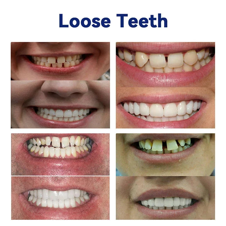 NESLEMYâ˘-đڎAdvanced Customized Full Denture Set𦷠(â°Limited time discount last 30 minutesâ°)