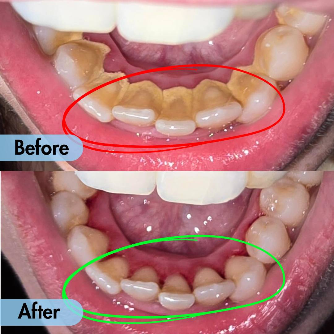 Ultrasonic Teeth Cleaner