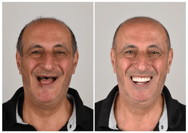 𦷠NESLEMY⢠Custom-Fit Functional Dentures š Smile with Confidence
