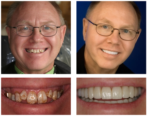 𦷠NESLEMY⢠Custom-Fit Functional Dentures š Smile with Confidence