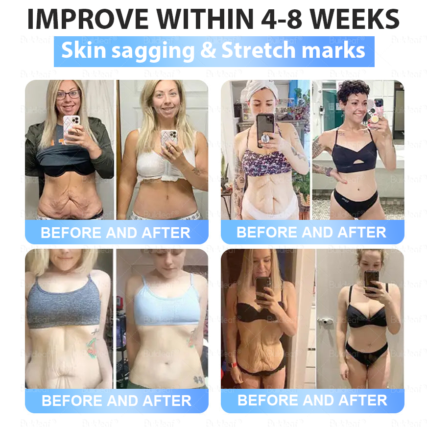 🏥FDA Official Store | 𝐵uil𝗱𝐿ea𝐟® 𝑮𝐋𝑃-1 Slim & Firm 𝑁ano 𝑀icroneedle 𝑃atch with Collagen, Turmeric & Matrixyl 3000丨Obesity, Cardiovascular Disease, Diabetes, Sleep Apnea, Joint Problems and More