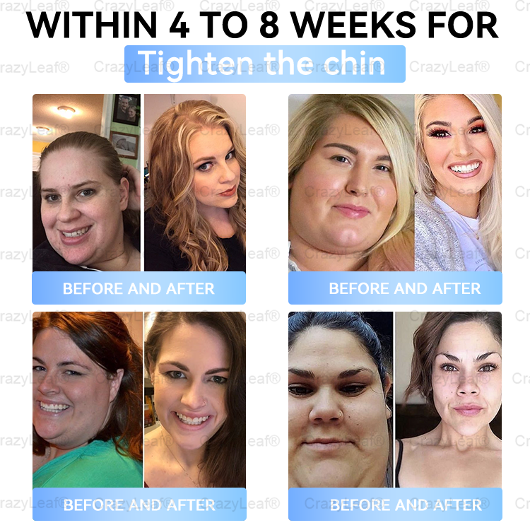 🏥FDA Official Store | 𝐵uil𝗱𝐿ea𝐟® 𝑮𝐋𝑃-1 Slim & Firm 𝑁ano 𝑀icroneedle 𝑃atch with Collagen, Turmeric & Matrixyl 3000丨Obesity, Cardiovascular Disease, Diabetes, Sleep Apnea, Joint Problems and More
