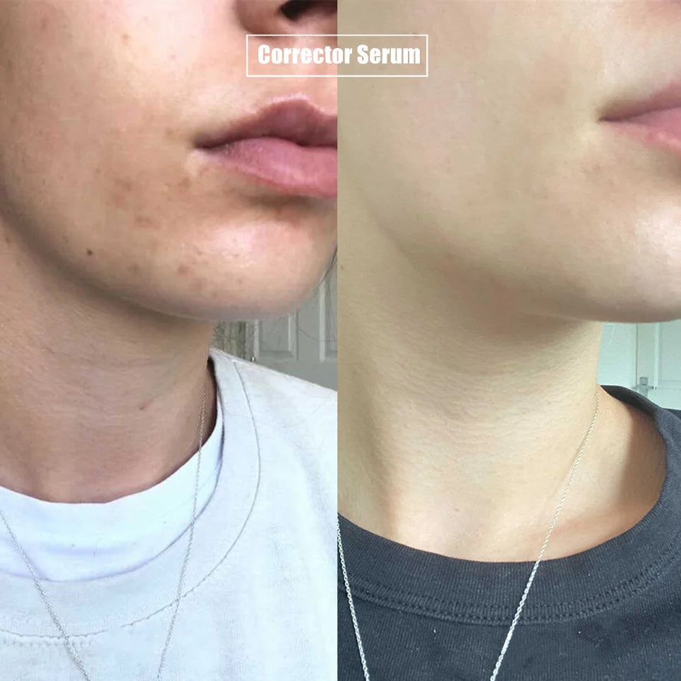 🔥Last Day 49% OFF🔥-Dark Spot Corrector Daily Face Serum