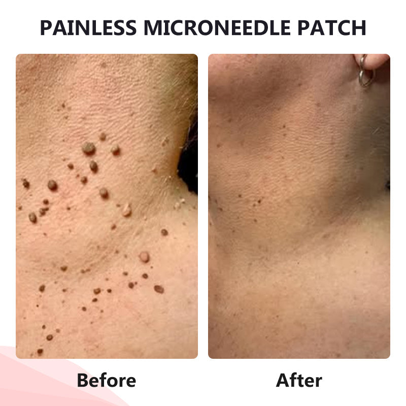 đ„painless micro-patchđ„