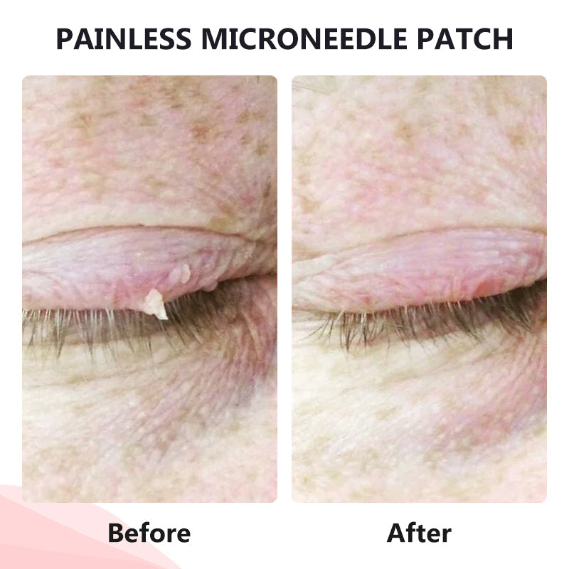 đ„painless micro-patchđ„