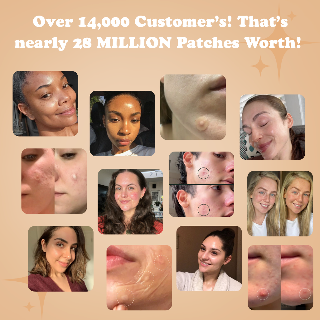 Hydrocolloid Acne Roll