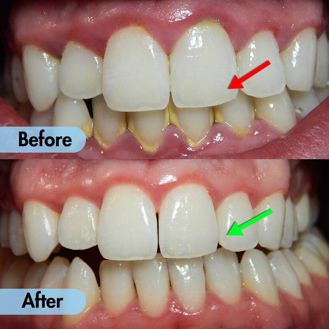 Ultrasonic Teeth Cleaner