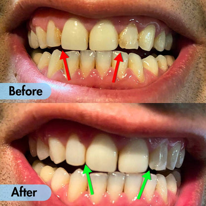 Ultrasonic Teeth Cleaner