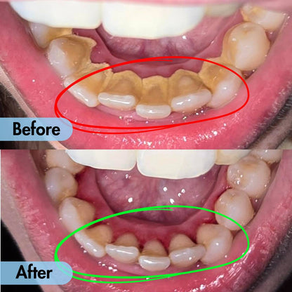 Ultrasonic Teeth Cleaner