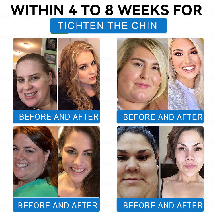 [Mayo Clinic Recommended] I Official Store | CrazyLeaf® SMGT-GLP-1 Nano Microneedle Slim & Firm Patch｜Slimming + Skin Tightening + Blood Sugar Support｜Regain your figure in 7 days｜No Injection Needed(Painless, Long-Lasting)