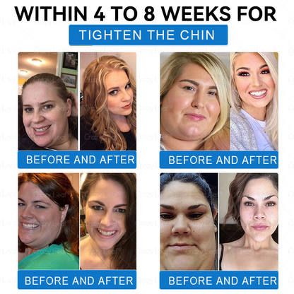 [Mayo Clinic Recommended] I Official Store | CrazyLeaf® SMGT-GLP-1 Nano Microneedle Slim & Firm Patch｜Slimming + Skin Tightening + Blood Sugar Support｜Regain your figure in 7 days｜No Injection Needed(Painless, Long-Lasting)