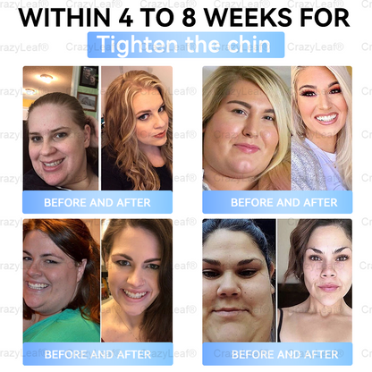 🏥FDA Official Store | 𝐵uil𝗱𝐿ea𝐟® 𝑮𝐋𝑃-1 Slim & Firm 𝑁ano 𝑀icroneedle 𝑃atch with Collagen, Turmeric & Matrixyl 3000丨Obesity, Cardiovascular Disease, Diabetes, Sleep Apnea, Joint Problems and More