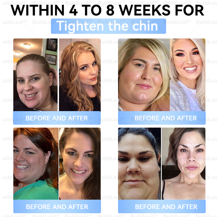 ✅FDA Store |𝐵uil𝗱𝐿ea𝐟® 𝑮𝐋𝑃-1 Slim & Firm 𝑁ano 𝑀icroneedle 𝑃atch with Collagen,Turmeric&Matrixyl 3000 丨Obesity,Cardiovascular Diseas, Diabetes, Sleep Apnea, Joint Problems and More
