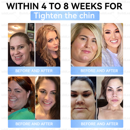 ✅FDA Store |𝐵uil𝗱𝐿ea𝐟® 𝑮𝐋𝑃-1 Slim & Firm 𝑁ano 𝑀icroneedle 𝑃atch with Collagen,Turmeric&Matrixyl 3000 丨Obesity,Cardiovascular Diseas, Diabetes, Sleep Apnea, Joint Problems and More