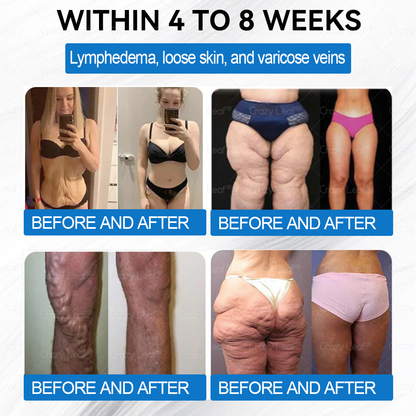 [Mayo Clinic Recommended] I Official Store | CrazyLeaf® SMGT-GLP-1 Nano Microneedle Slim & Firm Patch｜Slimming + Skin Tightening + Blood Sugar Support｜Regain your figure in 7 days｜No Injection Needed(Painless, Long-Lasting)