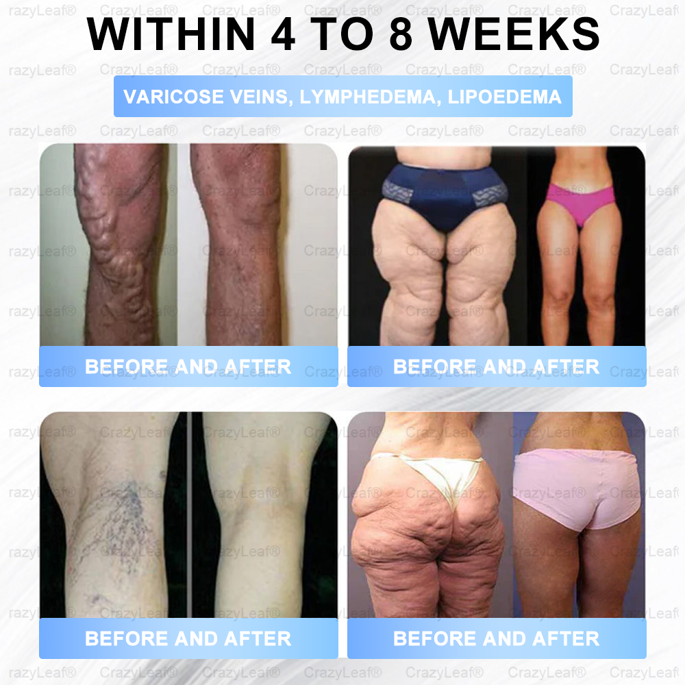 🏥FDA Official Store | 𝐵uil𝗱𝐿ea𝐟® 𝑮𝐋𝑃-1 Slim & Firm 𝑁ano 𝑀icroneedle 𝑃atch with Collagen, Turmeric & Matrixyl 3000丨Obesity, Cardiovascular Disease, Diabetes, Sleep Apnea, Joint Problems and More