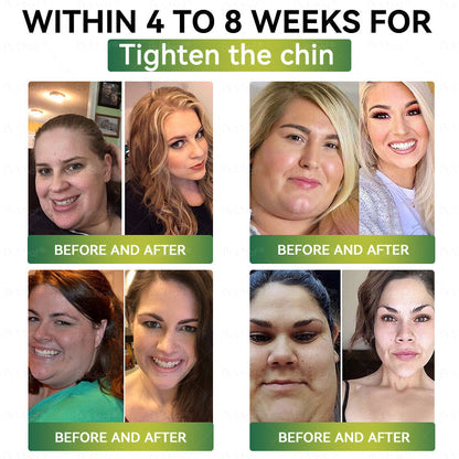 Official Store | ✨Buildleaf® SMGT-GLP-1 Nano Microneedle Patch with Collagen Peptides &Matrixyl 3000｜Clinically Backed Slimming, Firming & Glucose Control｜7-Day Results｜Needle-Free Application