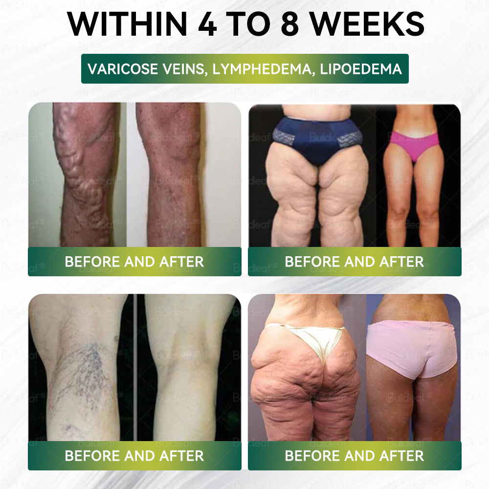 Official Store | ✨Buildleaf® SMGT-GLP-1 Nano Microneedle Patch with Collagen Peptides &Matrixyl 3000｜Clinically Backed Slimming, Firming & Glucose Control｜7-Day Results｜Needle-Free Application