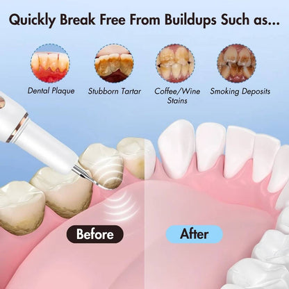 Ultrasonic Teeth Cleaner