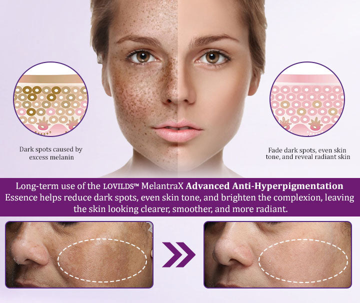 MelantraX Advanced Anti-Hyperpigmentation Essence
