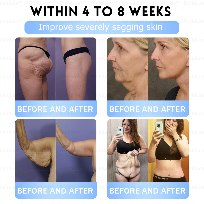 🏥FDA Official Store | 𝐵uil𝗱𝐿ea𝐟® 𝑮𝐋𝑃-1 Slim & Firm 𝑁ano 𝑀icroneedle 𝑃atch with Collagen, Turmeric & Matrixyl 3000丨Obesity, Cardiovascular Disease, Diabetes, Sleep Apnea, Joint Problems and More