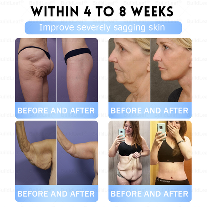 🏥FDA Official Store | 𝐵uil𝗱𝐿ea𝐟® 𝑮𝐋𝑃-1 Slim & Firm 𝑁ano 𝑀icroneedle 𝑃atch with Collagen, Turmeric & Matrixyl 3000丨Obesity, Cardiovascular Disease, Diabetes, Sleep Apnea, Joint Problems and More