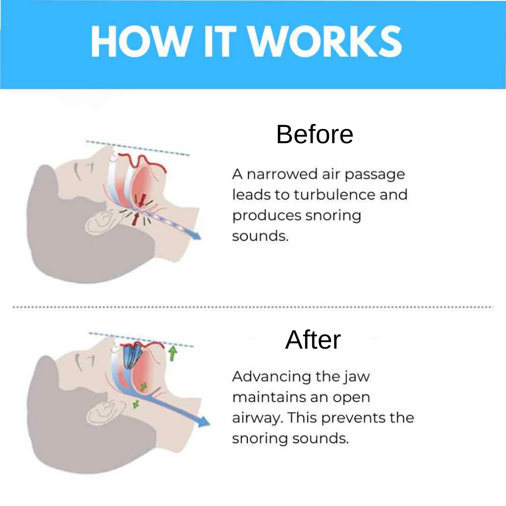 Anti-Snoring Mouthpiece