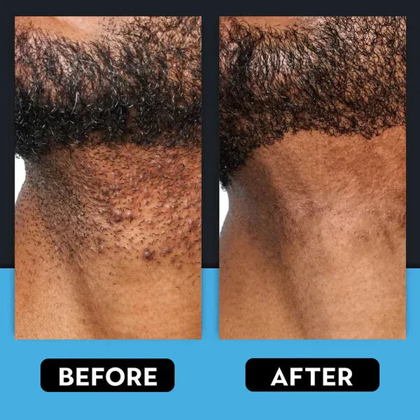 🎁Last day 80% OFF🎁Razor Bump & Ingrown Hair Treatment