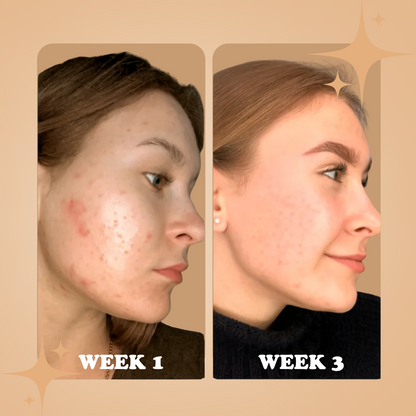 Hydrocolloid Acne Roll